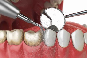 Dental Scaling