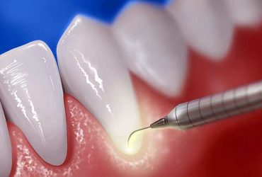 Periodontal Treatment