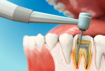 Root Canal Treatment