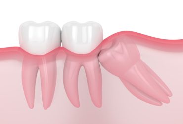 Thirdmolar Impaction Surgery