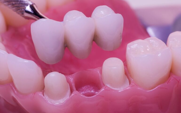 dental-bridges-min-e1531156996390