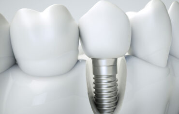 Dental Implant & Dental Bridge