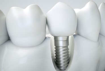 Dental Implant & Dental Bridge