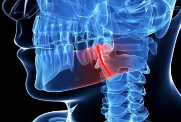 Jaw Fractures Cases