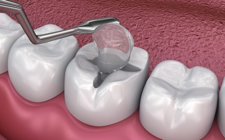 new-type-of-dental-fillings-1024x683